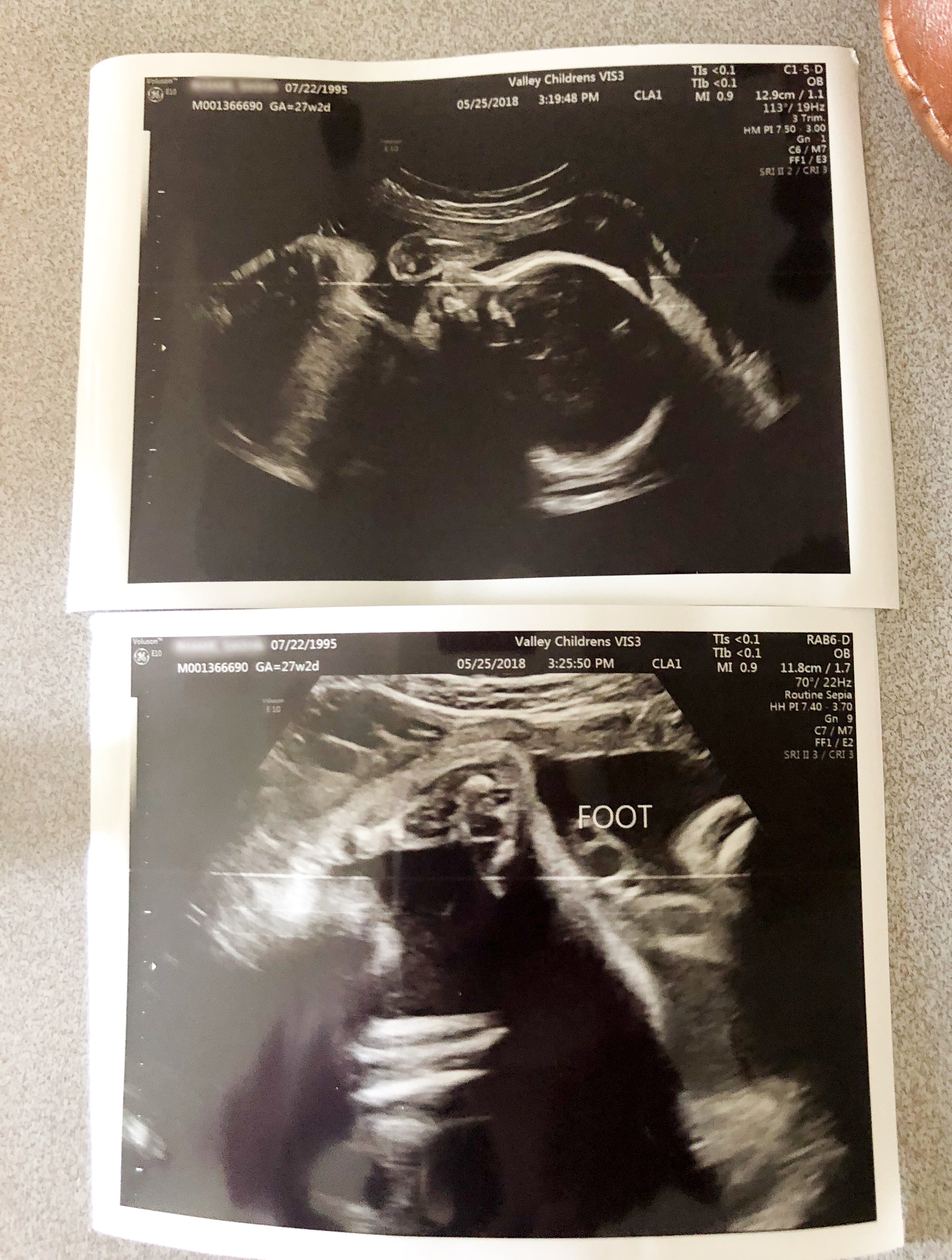 two sonograms of a mosie baby