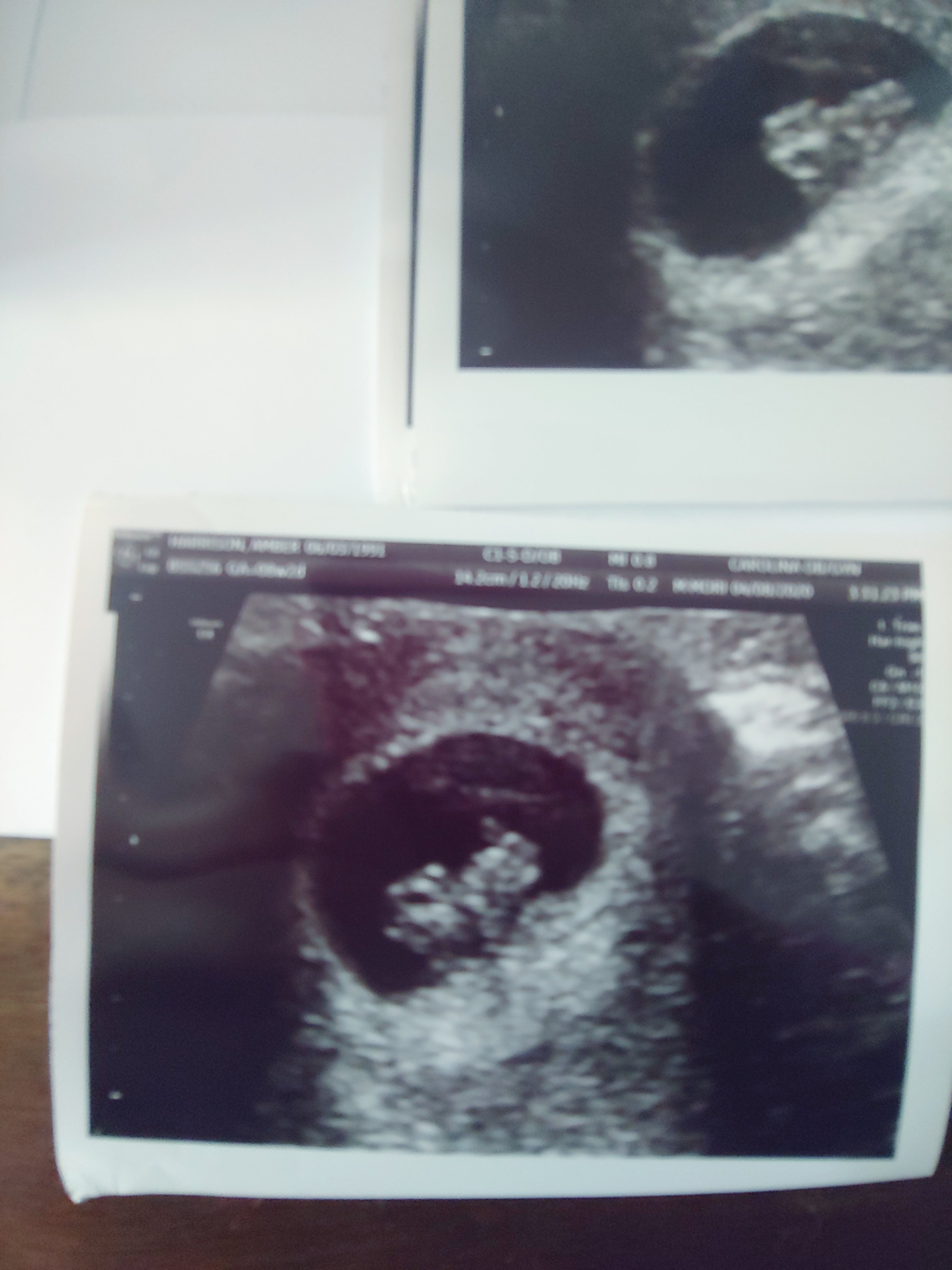 Two separate sonogram images of a Mosie Baby in utero.