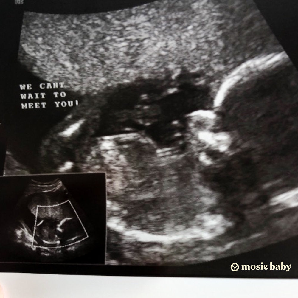 Sonogram ultrasound of a Mosie Baby