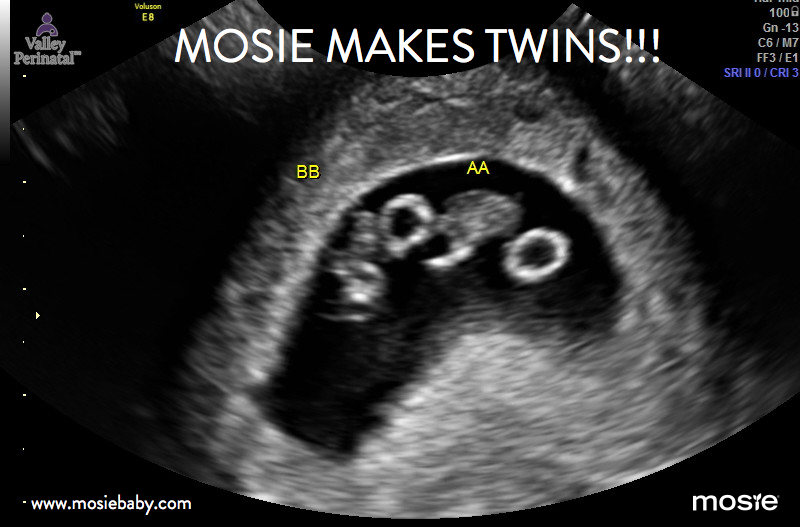 a sonogram of mosie baby twins
